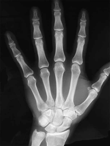 Hand Wrist Radiographs
