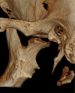 TMJ (Jaw Joint) Imaging